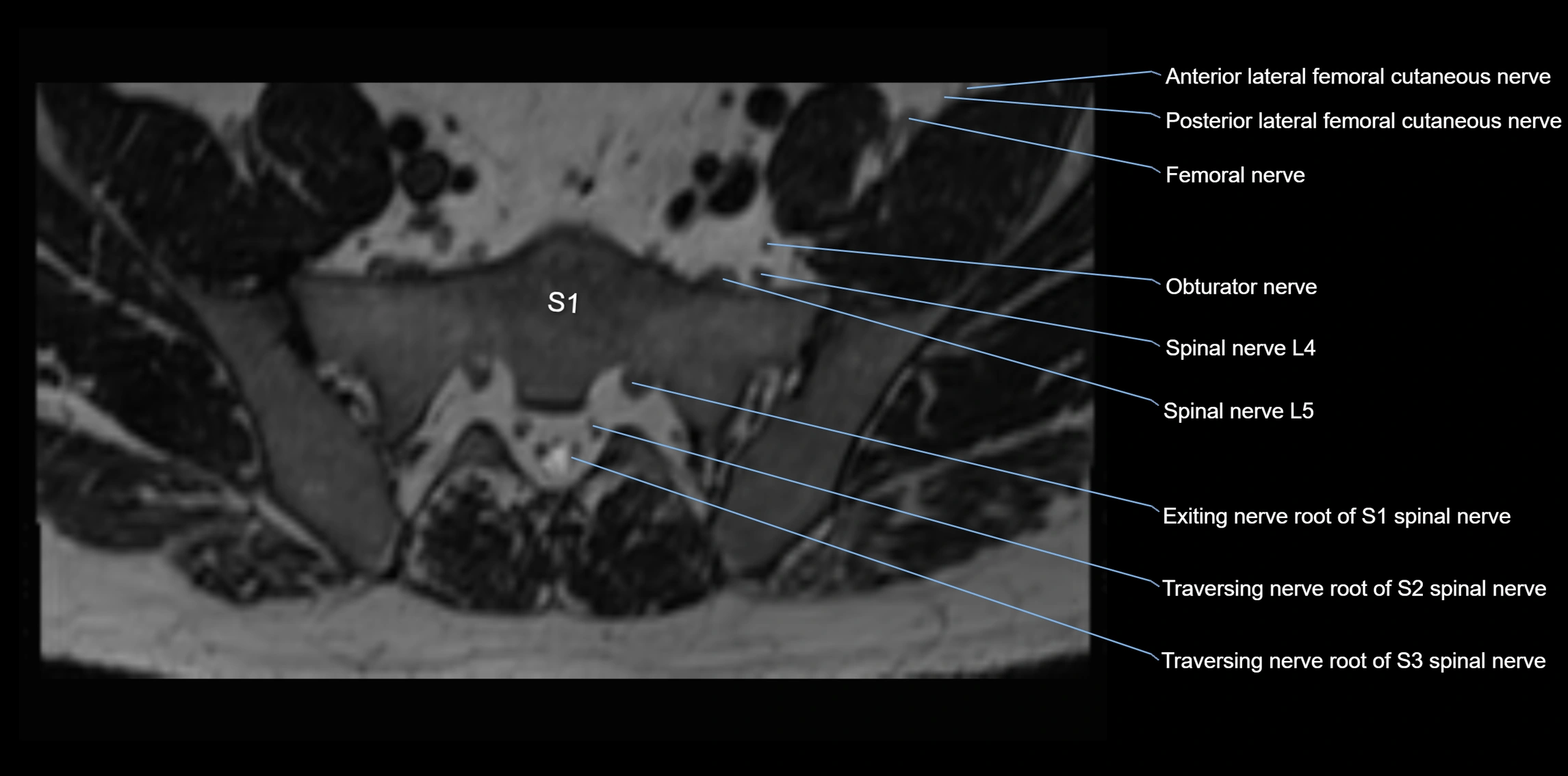 MR lumbosacral plexus axial cross sectional anatomy 3T  radiology  image-img-1008001-00074.webp